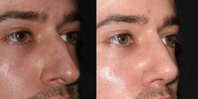 Ervaring in neuscorrecties komt met de tijd. Met een beetje geluk ontwikkel je na jarenlange oefening je eigen esthetisch oordeel en kom je dichter bij het definiëren van je persoonlijke stijl. Neuscorrecties bij mannen zijn bijzonder uitdagend. Deze neuscorrectie ziet er drie maanden na de operatie vanuit elke hoek beter uit en de ademhaling van de patiënt is ook verbeterd. De neus heeft nog steeds sterke, mannelijke trekken – precies zoals bedoeld. [16:41, 27-09-2026] Peter Lohuis: Daar gaan we! [16:41, 27-09-2026] Peter Lohuis: * Vermindering van de neusrugbult * Neusvergroting * Correctie van de neusluchtweg * Neusreconstructie * Verfijning van de neuspunt * Neusverkleining * Vermindering van de neusbasis * Correctie van een scheve neus * Septoplastie