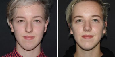 Neuscorrectie vrouw voor en na