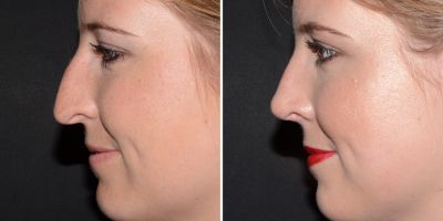 Neuscorrectie vrouw voor en na