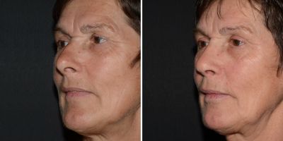 Neuscorrectie vrouw voor en na
